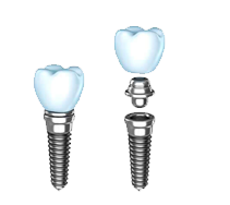 Nobrega Odontologia Alphaville - Implantes