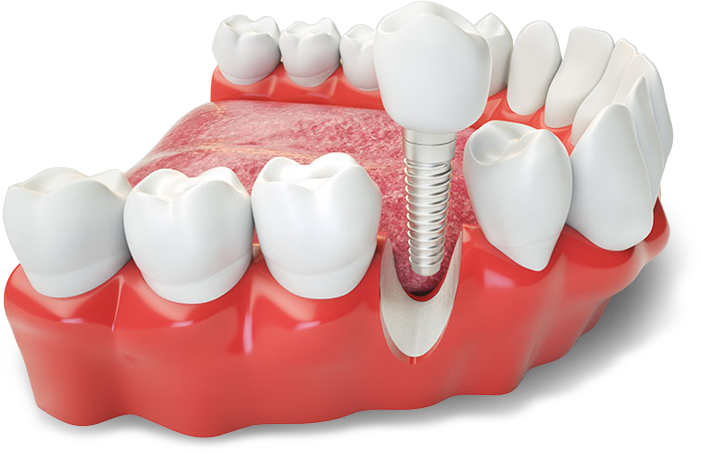 Nobrega Odontologia Alphaville - Implantes