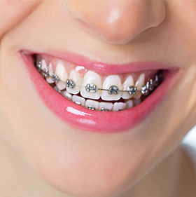 Aparelho Odontológico Ortodontia
