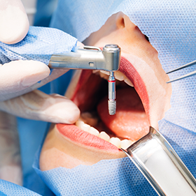 Cirurgias Odontológicas
