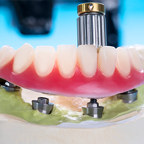 Dentadura – Overdenture